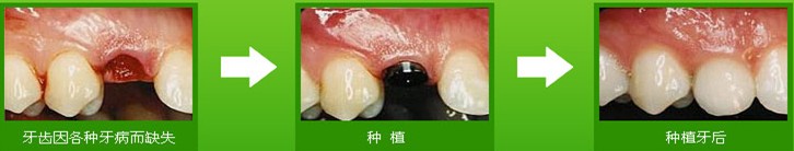 門牙掉了怎么修補