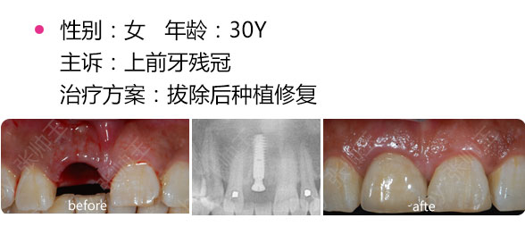 拔牙后可以馬上種牙嗎？