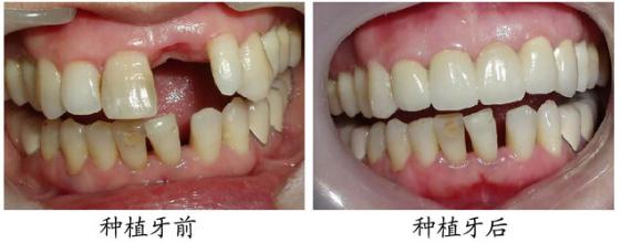 微創(chuàng)速導種植如何保障率？
