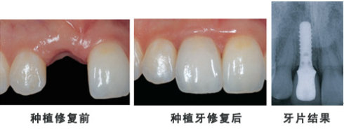 種牙不當(dāng)會(huì)帶來5大傷害