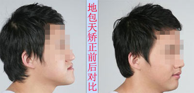 深圳地包天矯正多少錢？