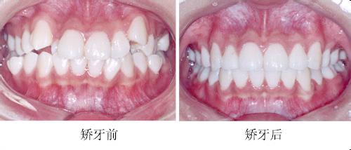深圳牙齒矯正需要多長時間？