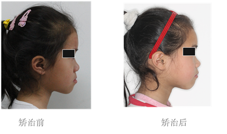 為何說兒童地包天3-5歲矯治較好？