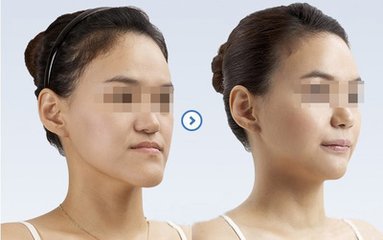 地包天什么時候矯正比較好？