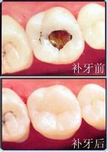 深圳補(bǔ)蛀牙要多少錢(qián)？