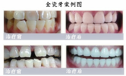 烤瓷牙矯正牙齒的優(yōu)勢(shì)有哪些？