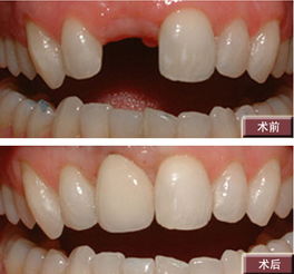 門(mén)牙種植牙要多少錢(qián)？