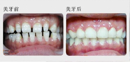 門牙有縫能做烤瓷牙修復(fù)嗎？
