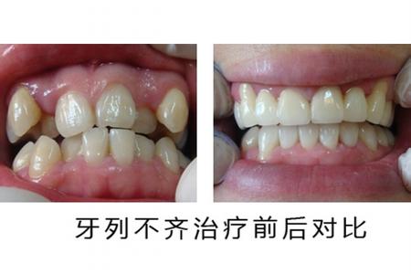 哪些因素會導(dǎo)致牙齒不齊？