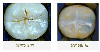 預(yù)防蛀牙做窩溝封閉真的有效嗎？