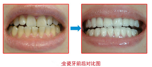 全瓷牙修復(fù)效果怎么樣？