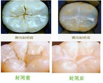 如何保障兒童窩溝封閉的效果？