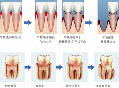 哪些牙周病可以通過洗牙來(lái)預(yù)防？