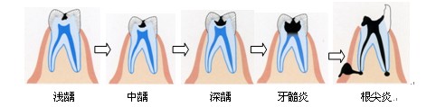 老年人患齲齒有哪些危害？