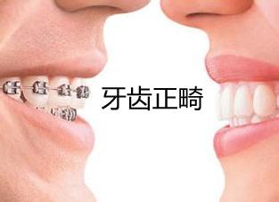 牙齒正畸治療后為什么會復(fù)發(fā)？