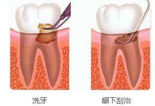 洗牙和牙周刮治有什么區(qū)別？