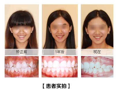 深圳牙齒不齊怎么辦？