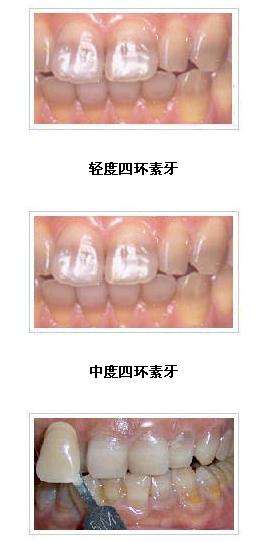 深圳四環(huán)素牙是什么？