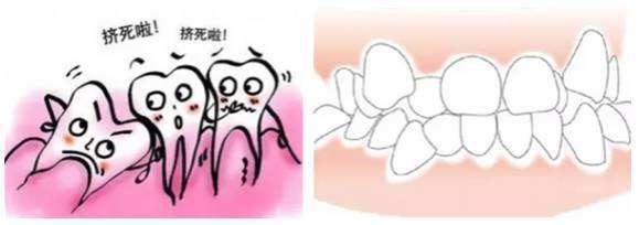 深圳智齒會(huì)使牙齒擁擠嗎？