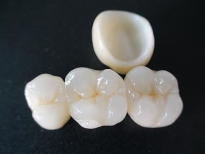 深圳全瓷牙多少錢(qián)一顆？