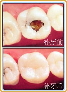 深圳蛀牙需要補(bǔ)牙嗎？