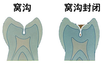 深圳窩溝封閉有必要嗎？