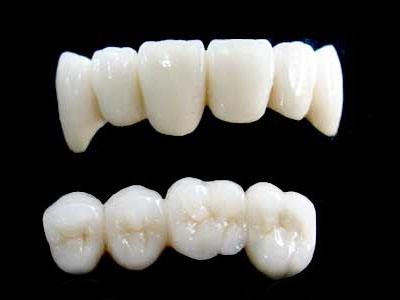 深圳全瓷烤瓷牙價(jià)格是多少？