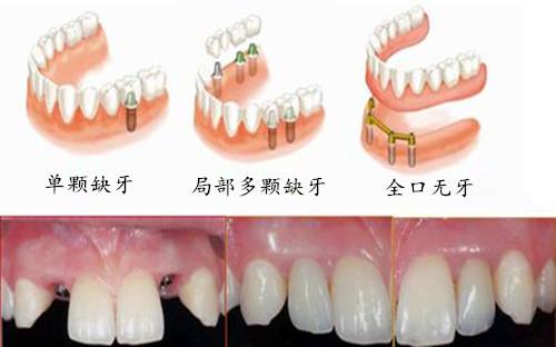 深圳種植牙齒價(jià)錢(qián)是多少？