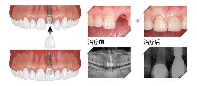 種一顆牙得多少錢？
