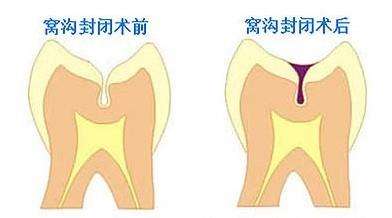 兒童窩溝封閉要不要做？