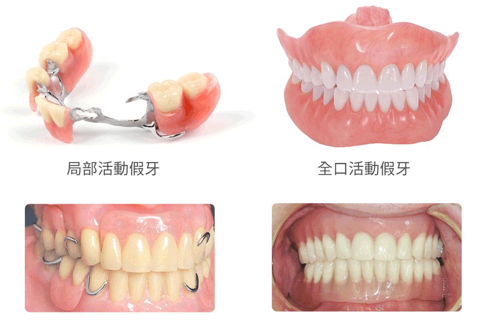 活動(dòng)假牙種類有哪些，價(jià)格又是多少？