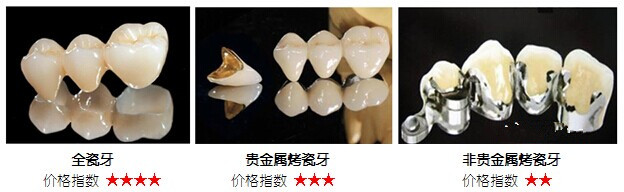 烤瓷牙和全瓷牙有什么區(qū)別？