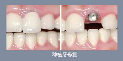門牙掉了一顆能種嗎？