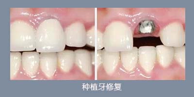 門牙缺失后可以做種植牙嗎？
