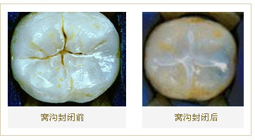 兒童窩溝封閉幾歲做比較合適？