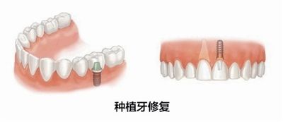 深圳鑲牙一般需要多少錢? 深圳鑲牙一般需要多少錢?