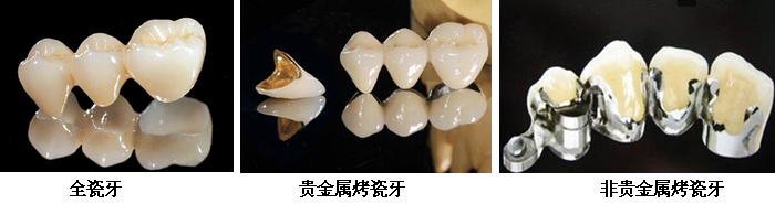 門牙烤瓷牙一般需要多少錢? 門牙烤瓷牙一般需要多少錢?