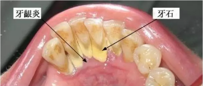 左氧氟沙星可以治療牙齦炎嗎？
