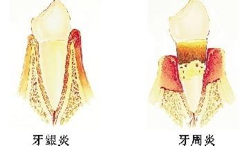 左氧氟沙星可以治療牙齦炎嗎？