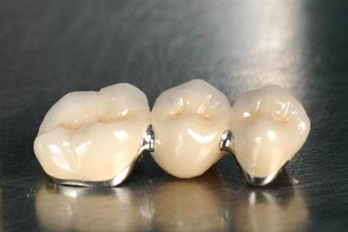 純鈦烤瓷牙還是全瓷牙好？