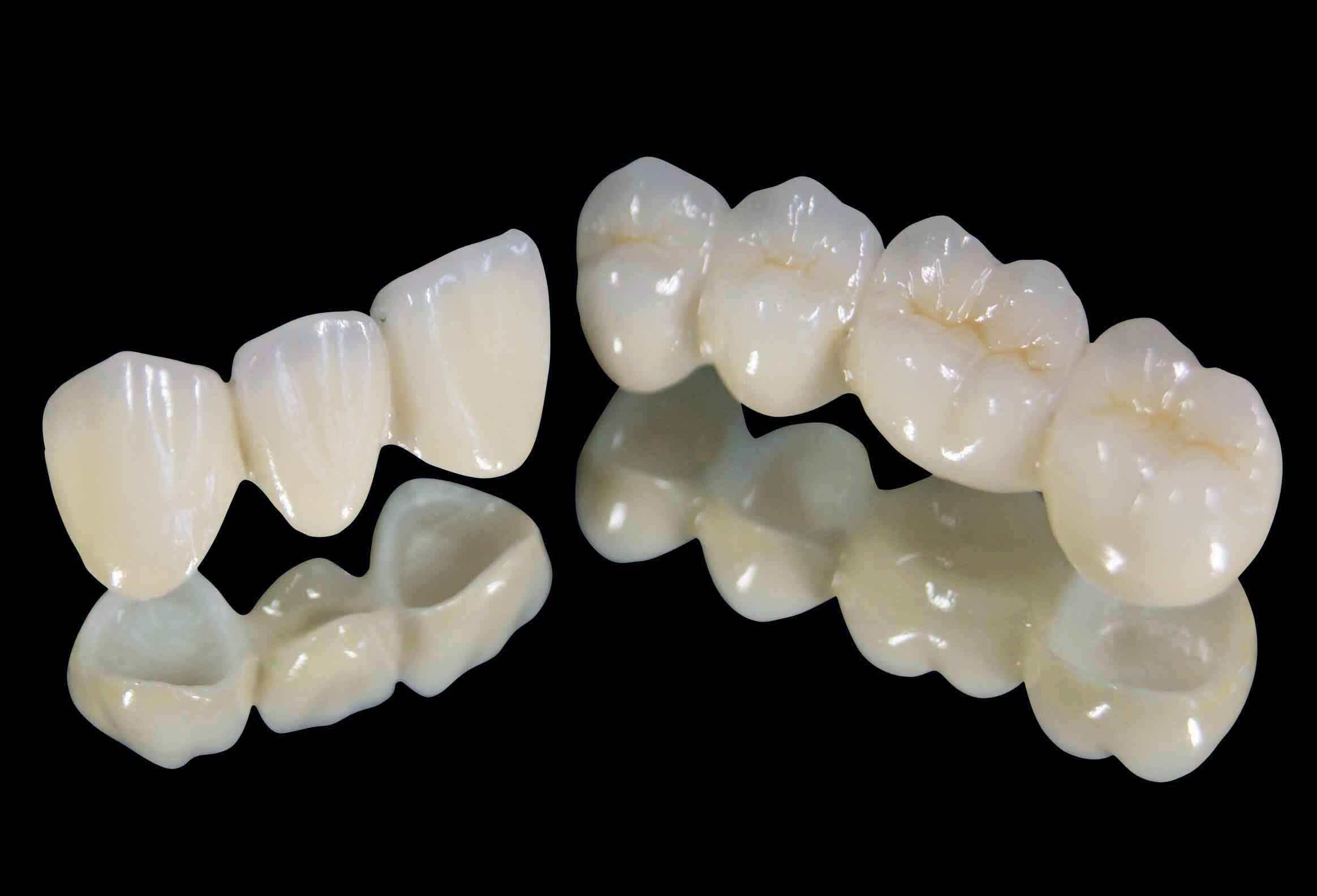 全烤瓷牙多少錢(qián)一顆? 全烤瓷牙多少錢(qián)一顆?