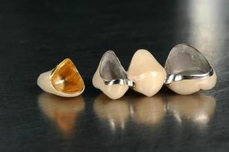 裝一個(gè)烤瓷牙多少錢? 裝一個(gè)烤瓷牙多少錢?