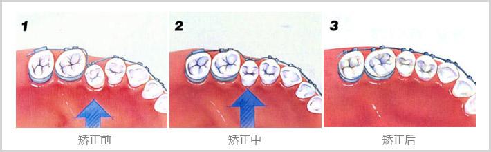 牙齒矯正的較佳時機(jī)是什么時候？