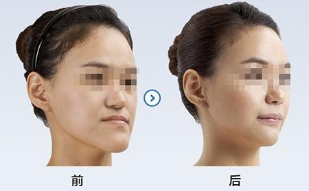 40歲了地包天還能矯正嗎？
