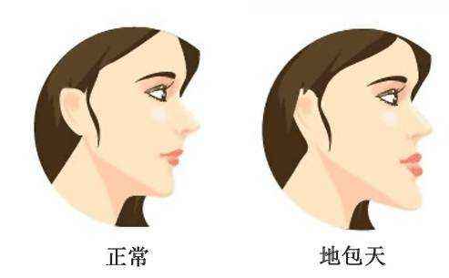 40歲了地包天還能矯正嗎？