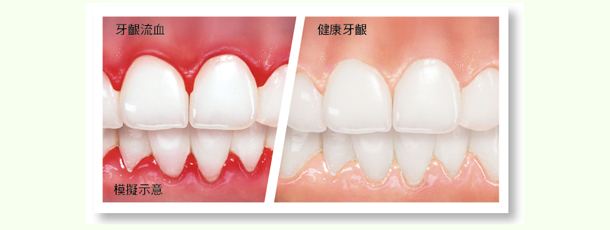 孕婦牙齦炎怎么治療？