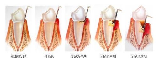 孕婦牙齦炎怎么治療？