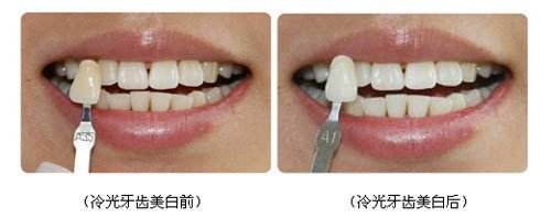 牙齒變色是不是壞死？該怎么修復(fù)呢？