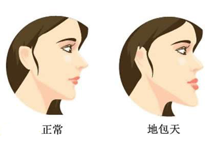 18歲地包天能矯正牙齒嗎? 18歲地包天能矯正牙齒嗎?