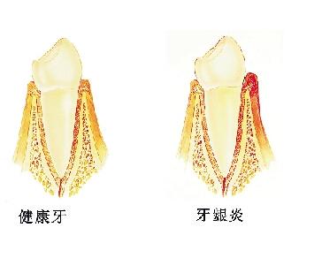 怎么治療牙齦炎？